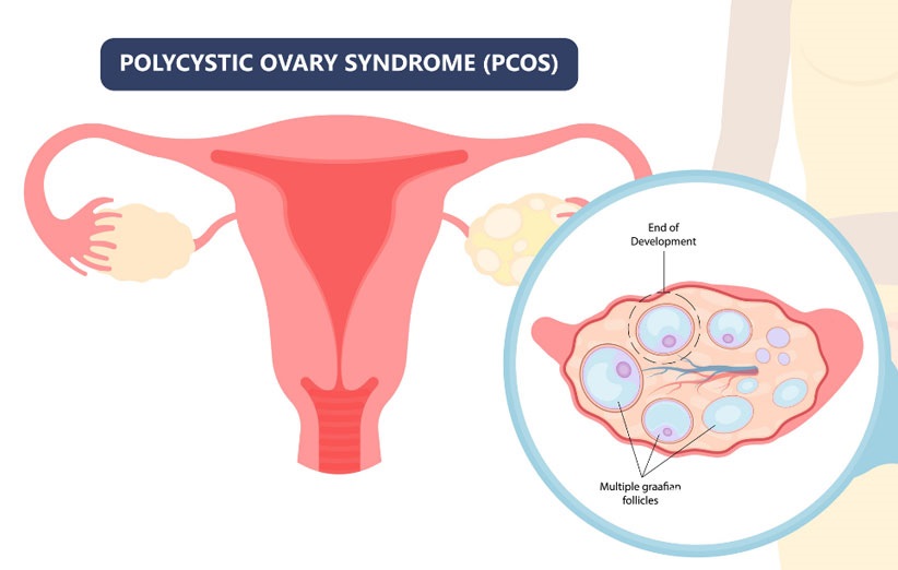 Polycystic Ovary Syndrome Disorder